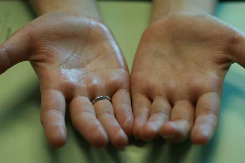 علت تعریق کف دست چیست؟ + درمان