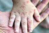 شناسایی ۲۰ مورد ابتلا به سرخک در استان فارس؛ بیماری تحت کنترل است